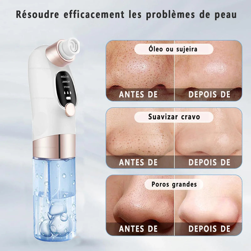 Removedor de Cravos com Sucção e Água – Limpeza Profunda, Antiacne, USB Recarregável com Função Microbolha